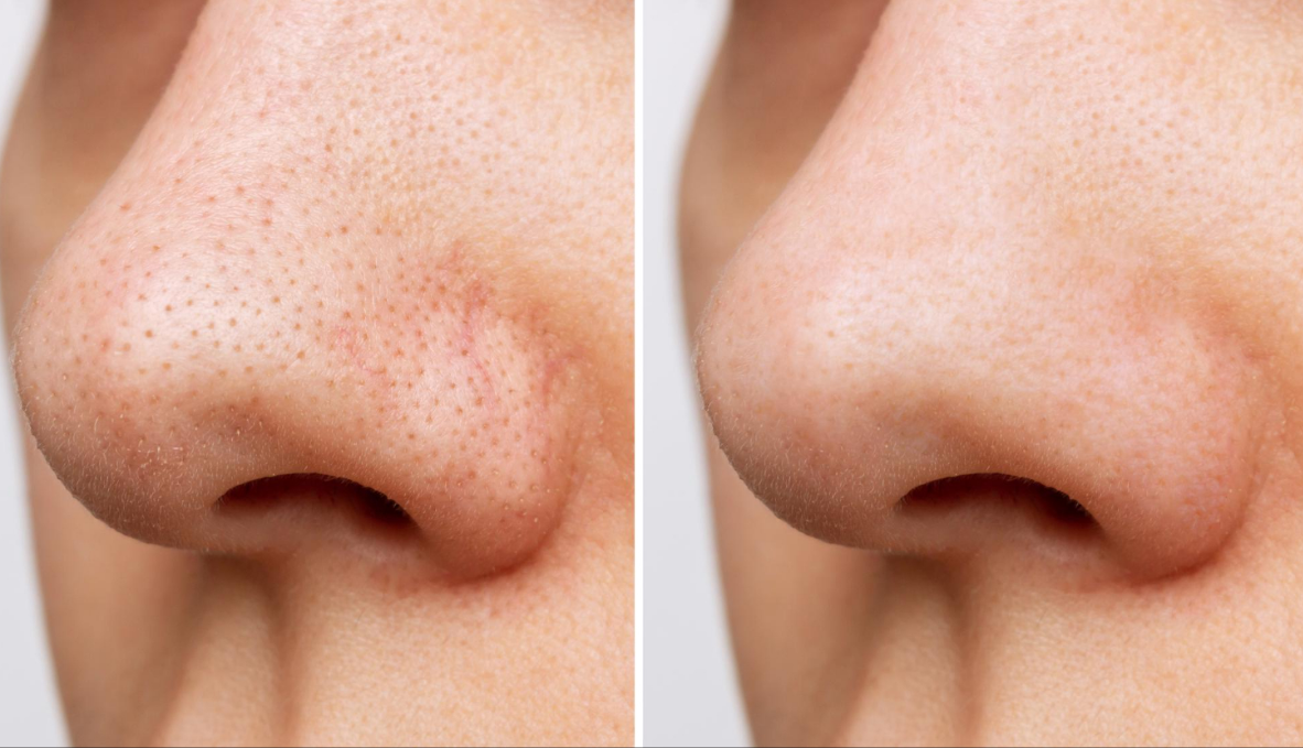 Sisone Blackhead Removal